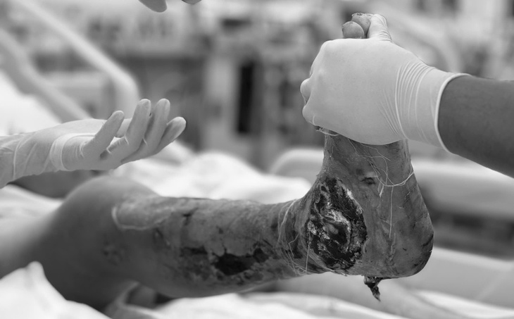 Thở máy ngay khi vào viện vì sai lầm tự chữa bệnh gout- Ảnh 3. Thở máy ngay khi vào viện vì sai lầm tự chữa bệnh gout- Ảnh 3.