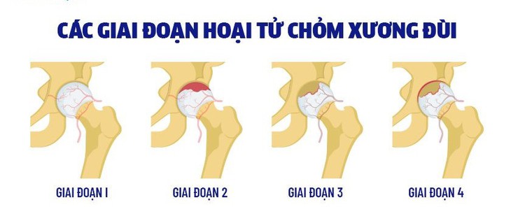 Bài tập nào tốt cho người hoại tử chỏm xương đùi?- Ảnh 1.