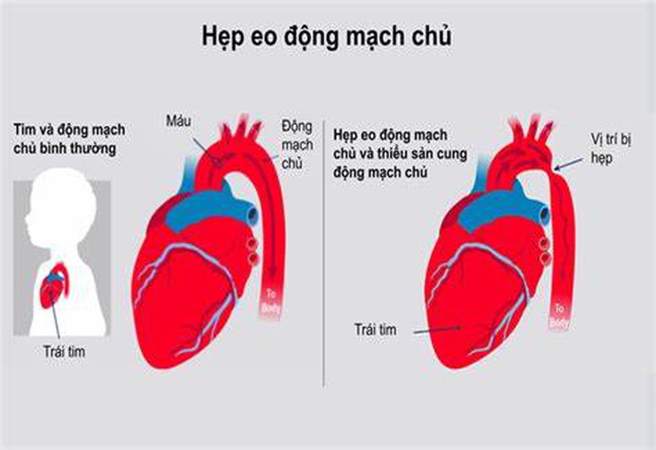 Bài tập nào tốt cho người hẹp eo động mạch chủ?- Ảnh 1.