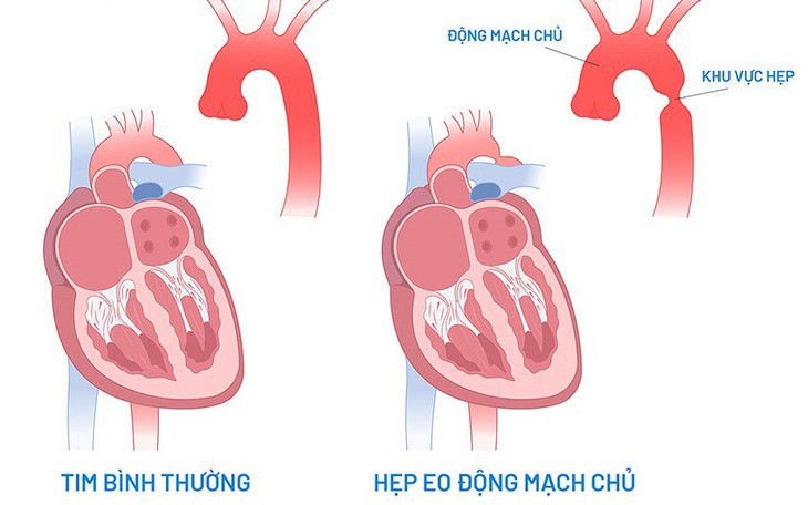Điều trị hẹp eo động mạch chủ như thế nào?