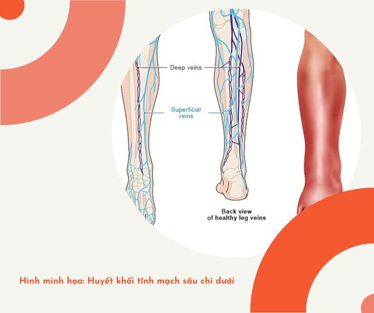 Các thuốc điều trị huyết khối tĩnh mạch sâu- Ảnh 1.