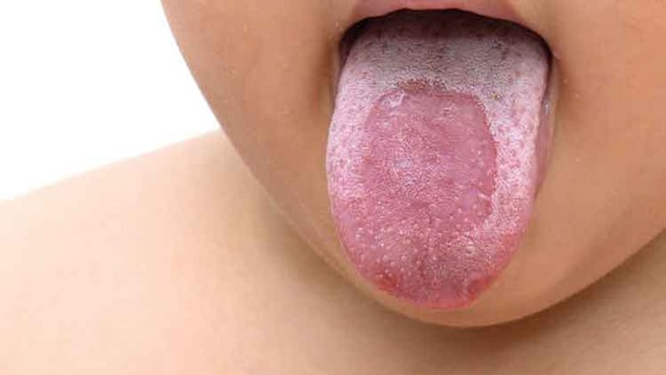 Thuốc điều trị lưỡi bản đồ- Ảnh 1. Thuốc điều trị lưỡi bản đồ- Ảnh 1.