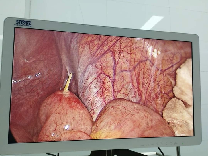 Nuốt phải tăm tre, một cô gái bị thủng ruột non- Ảnh 1.