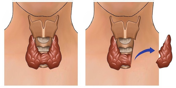 Hiểu về bướu cổ để xử lý bệnh hiệu quả- Ảnh 2.