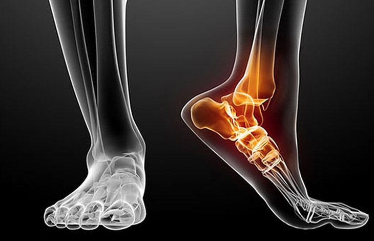 Thoái hóa khớp cổ chân do đâu?- Ảnh 1. Thoái hóa khớp cổ chân do đâu?- Ảnh 1.