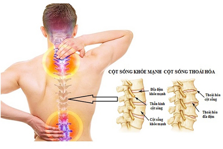 Thoái hóa cột sống thắt lưng là bệnh thường gặp. Nếu nắm được các giai đoạn của bệnh sẽ giúp bạn có hướng điều trị và phòng bệnh hiệu quả.