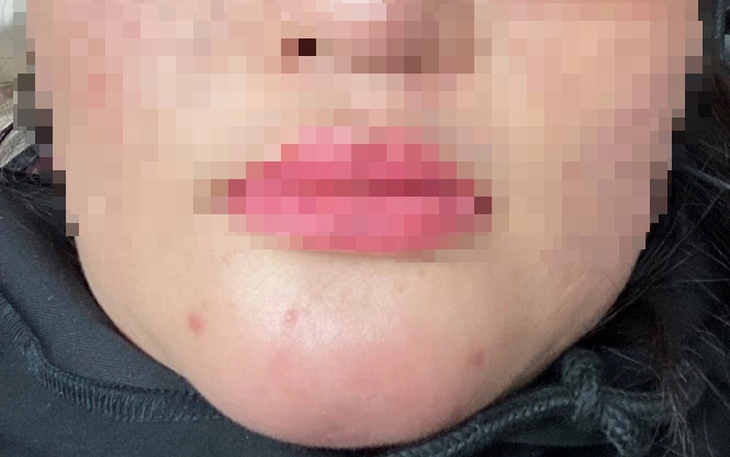 Tiêm filler cằm, một phụ nữ bị chảy dịch mủ trong miệng