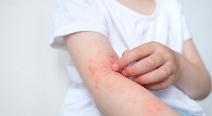 Thuốc mới trị viêm da dị ứng- Ảnh 1. Thuốc mới trị viêm da dị ứng- Ảnh 1.