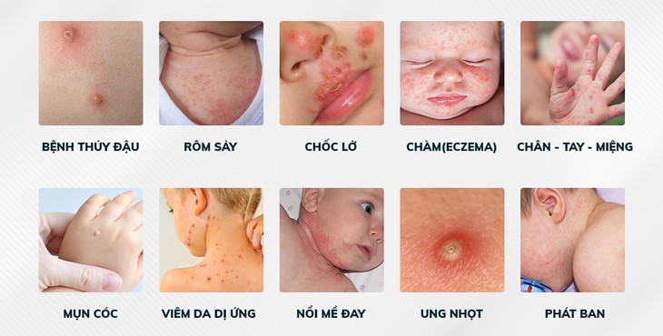 Giải pháp cho các bệnh da hay gặp ở trẻ sơ sinh- Ảnh 3.