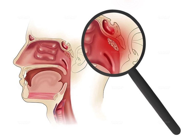 Ung thư vòm họng: Biểu hiện, nguyên nhân, điều trị và phòng bệnh- Ảnh 1.