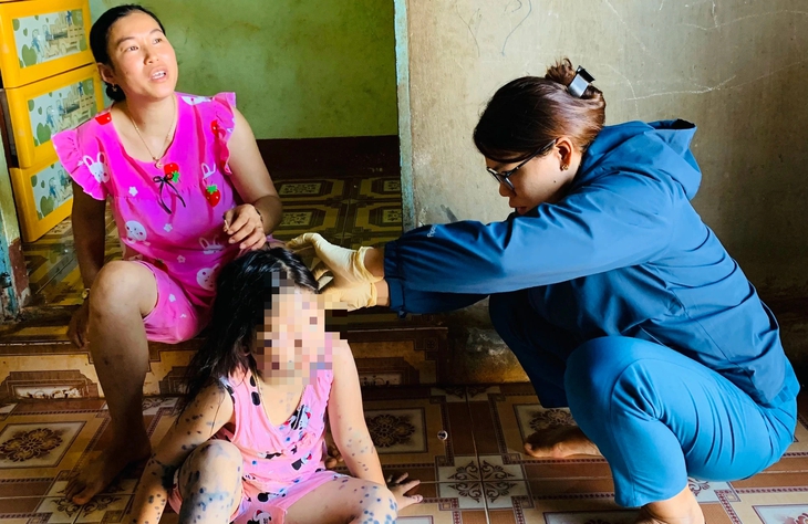 Xuất hiện ổ dịch thủy đậu người bệnh cần làm gì để nhanh khỏi- Ảnh 1. Xuất hiện ổ dịch thủy đậu người bệnh cần làm gì để nhanh khỏi- Ảnh 1.