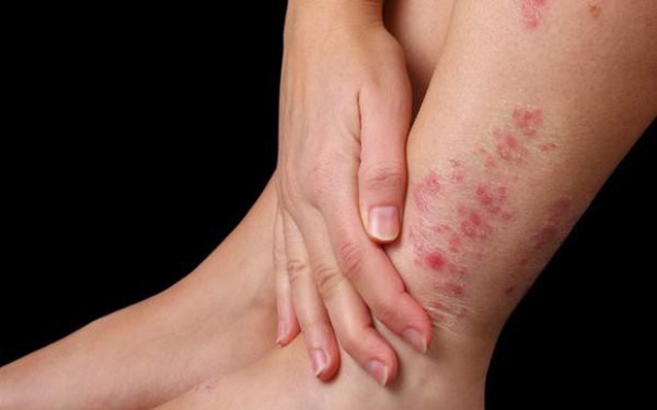 Viêm da cơ địa có nguy hiểm không?