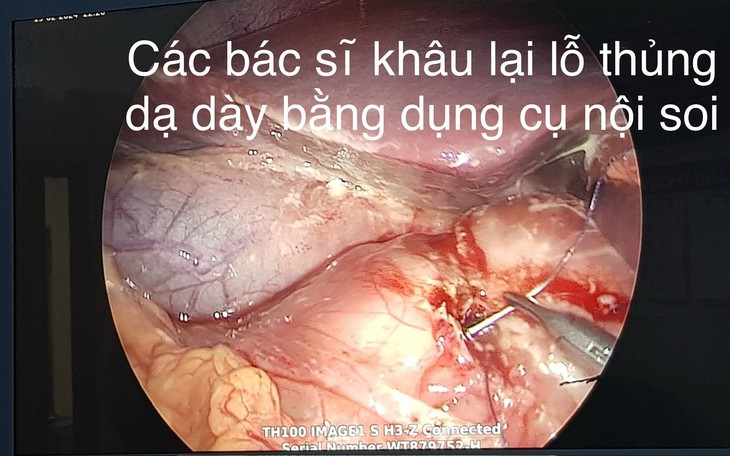 Nam sinh 15 tuổi bị thủng dạ dày vì thói quen ăn đồ chua cay