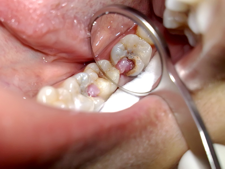 Chớ chủ quan với cơn đau răng- Ảnh 2. Chớ chủ quan với cơn đau răng- Ảnh 2.