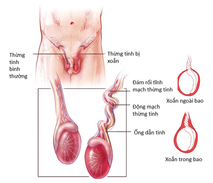Thanh niên 16 tuổi bất ngờ bị xoắn tinh hoàn trong đêm, nhờ hành động này mà bác sĩ đã cứu được 'cậu nhỏ'- Ảnh 2. Thanh niên 16 tuổi bất ngờ bị xoắn tinh hoàn trong đêm, nhờ hành động này mà bác sĩ đã cứu được 'cậu nhỏ'- Ảnh 2.