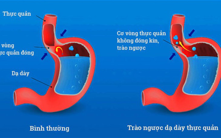 Các biến chứng nguy hiểm của trào ngược dạ dày thực quản