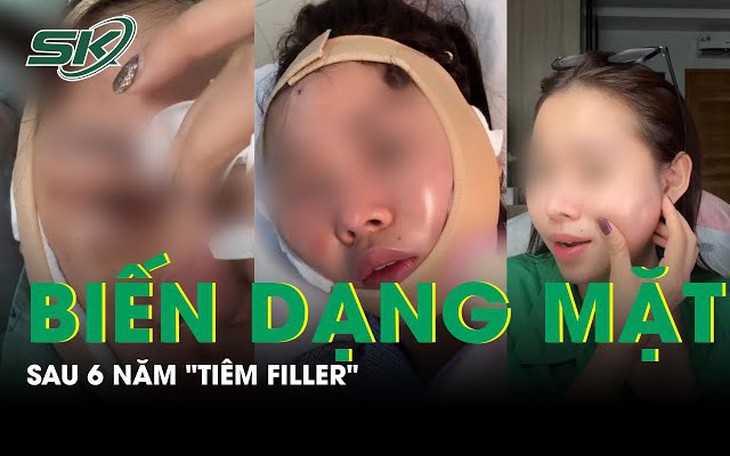 Nữ TikToker bị biến dạng mặt sau 6 năm tiêm filler