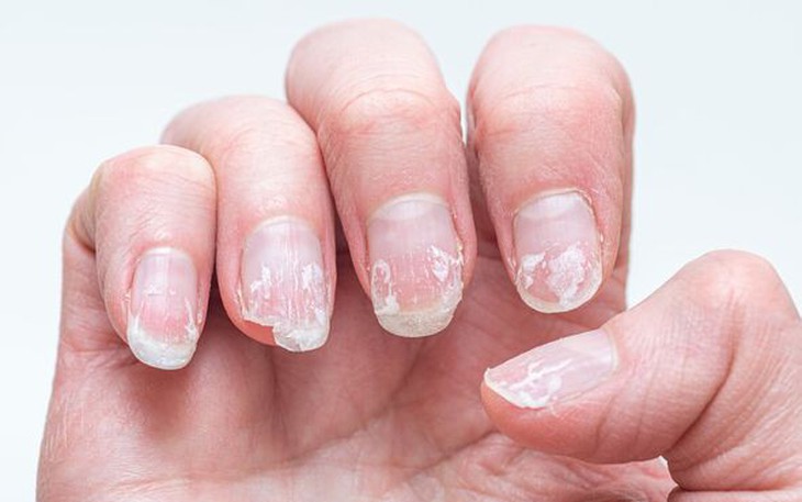 Móng mọc ngược gây đau xử trí thế nào?- Ảnh 1.
