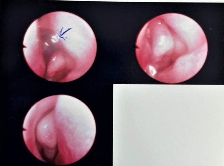 Tắm suối, bé 13 tháng tuổi bị vắt chui vào mũi- Ảnh 2.