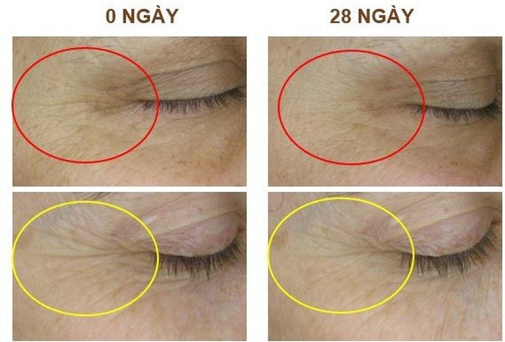 Bộ sản phẩm hỗ trợ giảm nhăn, hỗ trợ cải thiện chảy xệ da- Ảnh 2. Bộ sản phẩm hỗ trợ giảm nhăn, hỗ trợ cải thiện chảy xệ da- Ảnh 2.