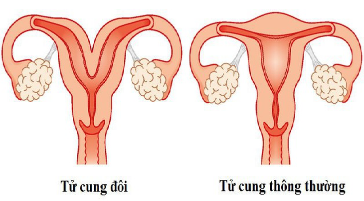 Bị dị tật tử cung đôi có sinh con được không?- Ảnh 1.