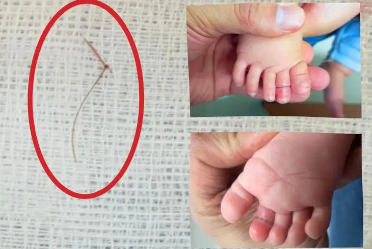 Dị vật thắt ngón chân là sợi tóc khiến bé giá 4 tháng tuổi suýt mất ngón chân.