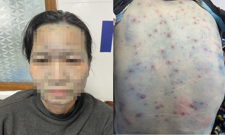 Người lớn bị thủy đậu có được tắm không?- Ảnh 2.