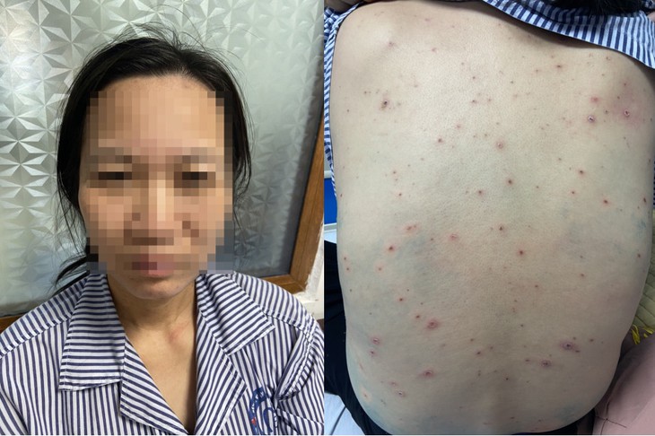 Lây thủy đậu từ học sinh, nữ giáo viên biến chứng nặng- Ảnh 2.