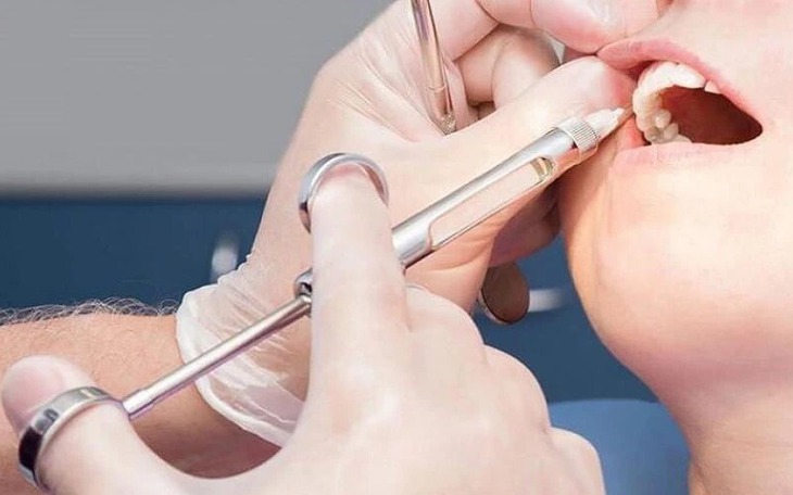Nội soi thành công cho bệnh nhi 8 tuổi bị kim diệt tủy rơi vào đường tiêu hóa