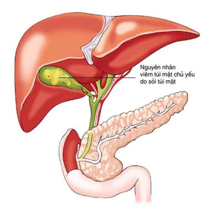 Y tế huyện cứu bệnh nhân sốc nhiễm trùng do viêm túi mật - Ảnh 1. Y tế huyện cứu bệnh nhân sốc nhiễm trùng do viêm túi mật - Ảnh 1.
