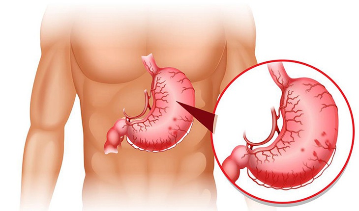Đau dạ dày thuộc nhóm bệnh khá phức tạp và rất dễ nhầm lẫn với nhiều bệnh khác, vì bệnh liên quan nhiều đến triệu chứng chức năng chủ quan của người bệnh.