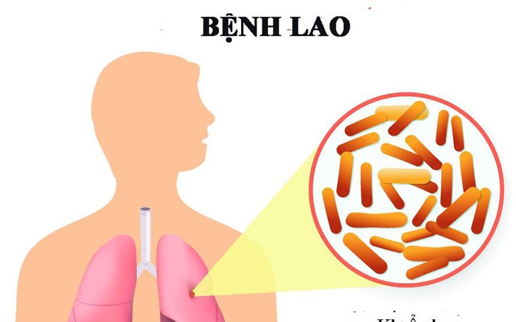 Lao phổi: Nguyên nhân, triệu chứng, đường lây truyền và cách điều trị