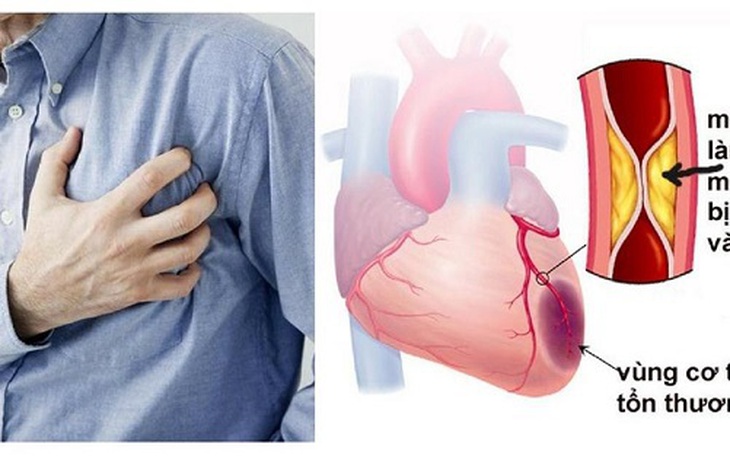 7 cách phòng ngừa nhồi máu cơ tim cấp, tránh nguy cơ ngừng tim