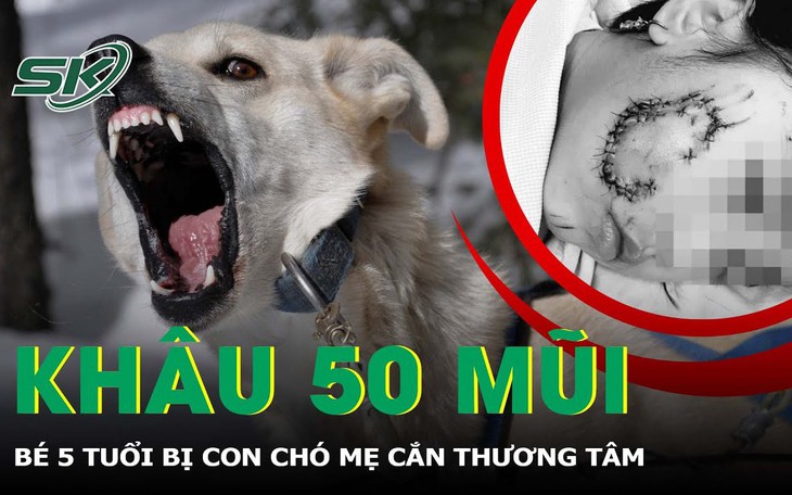 Bé 5 tuổi bị chó cắn phải khâu gần 50 mũi ở mặt