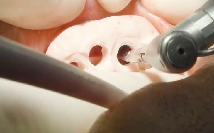 Máng định vị 3D Guide – Giảm nguy cơ biến chứng sau cấy ghép implant- Ảnh 3.