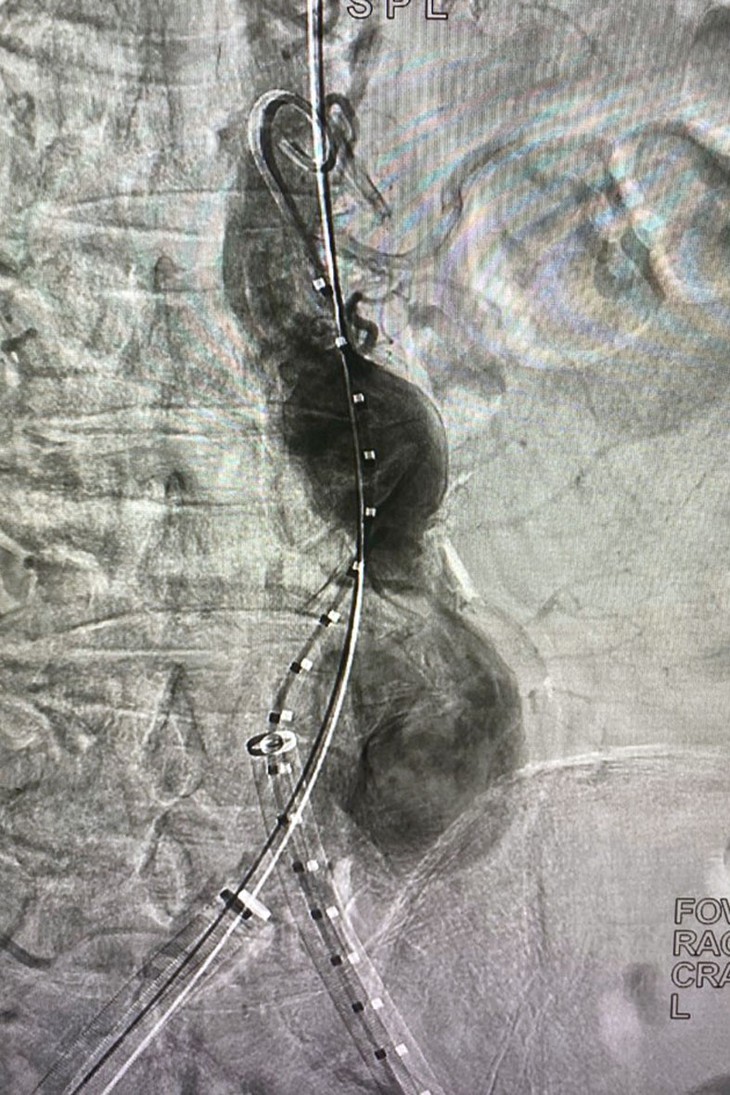Bệnh viện Hữu nghị Đa khoa Nghệ An triển khai thường quy kỹ thuật đặt Stent Graft- Ảnh 3.