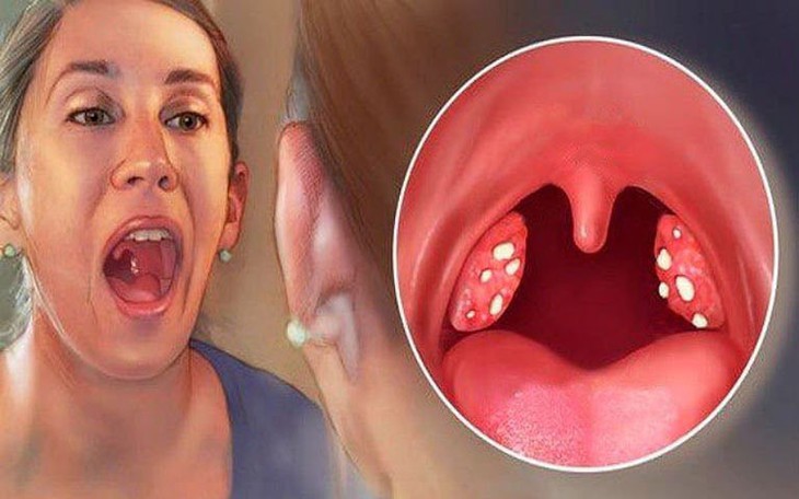Viêm họng: Nguyên nhân, triệu chứng, cách điều trị và phòng bệnh