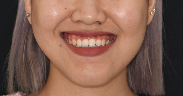 Cười hở lợi: tìm hiểu và lựa chọn đúng đắn- Ảnh 1.
