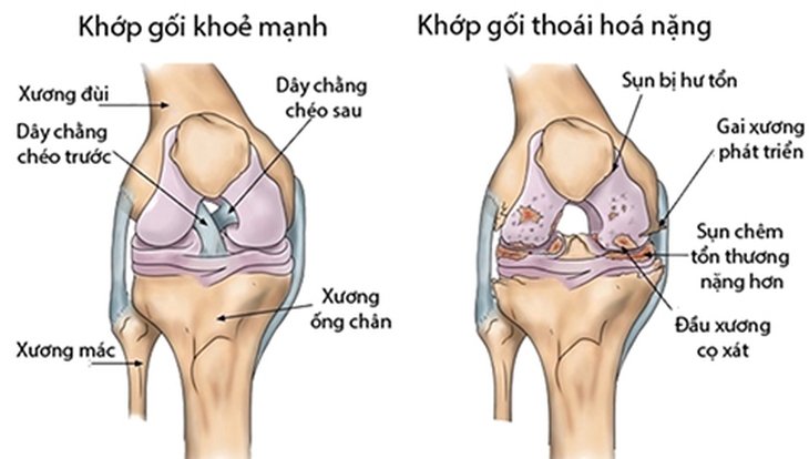 Điều trị gai khớp gối cho người cao tuổi- Ảnh 1.