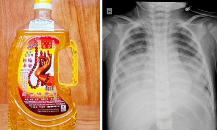 Nhiều trẻ ngộ độc thuốc và hóa chất nguy kịch, bác sĩ khuyến cáo cách phòng tránh- Ảnh 3.
