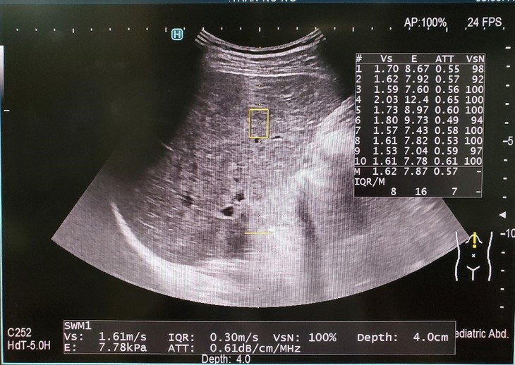 Bệnh viện Nội tiết Nghệ An - Địa chỉ tin cậy trong phát hiện xơ hóa gan sớm bằng kỹ thuật siêu âm đàn hồi mô- Ảnh 5. Bệnh viện Nội tiết Nghệ An - Địa chỉ tin cậy trong phát hiện xơ hóa gan sớm bằng kỹ thuật siêu âm đàn hồi mô- Ảnh 5.