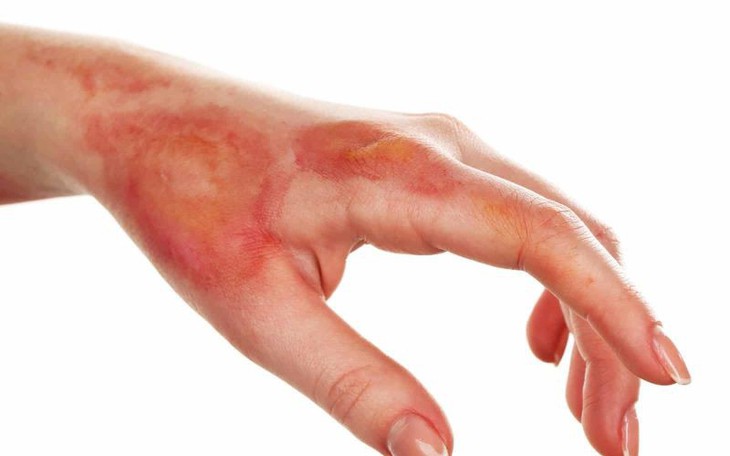 Bỏng: Nguyên nhân, chẩn đoán, điều trị và phòng bệnh