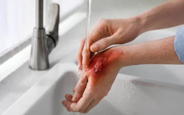 Câu hỏi thường gặp liên quan đến bỏng