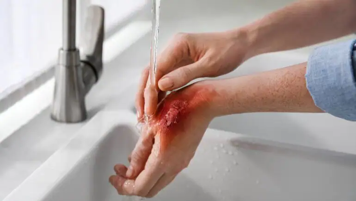 Câu hỏi thường gặp liên quan đến bỏng- Ảnh 1. Câu hỏi thường gặp liên quan đến bỏng- Ảnh 1.