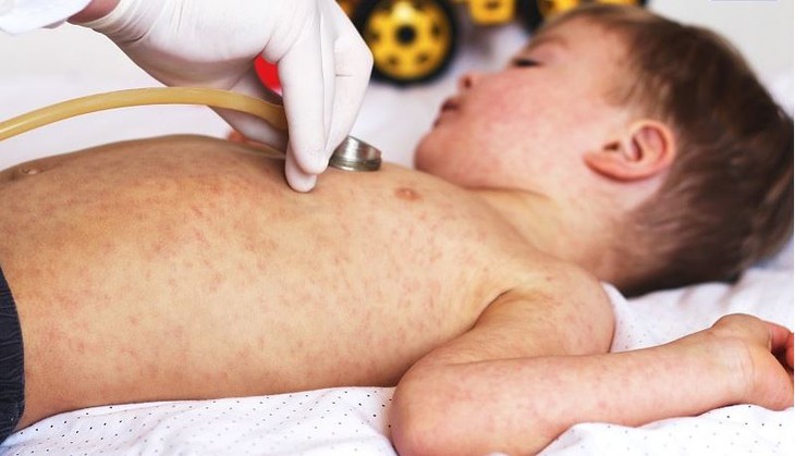 Rubella: Nguyên nhân, triệu chứng, đường lây truyền, cách điều trị và phòng bệnh- Ảnh 1. Rubella: Nguyên nhân, triệu chứng, đường lây truyền, cách điều trị và phòng bệnh- Ảnh 1.