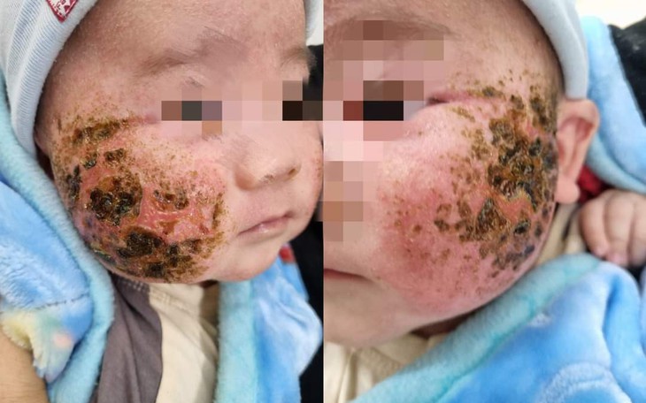 Tự đắp lá cây chữa viêm da, bé trai 4 tháng tuổi bị loét má