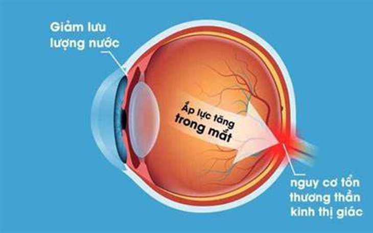 Phát hiện mới: Vitamin B3 giảm 66% nguy cơ mắc glôcôm ở người tăng nhãn áp? - Ảnh 2.