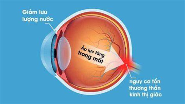 Tăng nhãn áp là gì? Phương pháp điều trị tăng nhãn áp - Cẩm Nang Tiếng Anh
