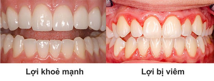 Viêm lợi chữa thế nào?- Ảnh 1. Viêm lợi chữa thế nào?- Ảnh 1.