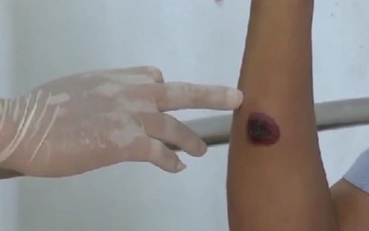 Lào phát hiện 3 người nhiễm bệnh than